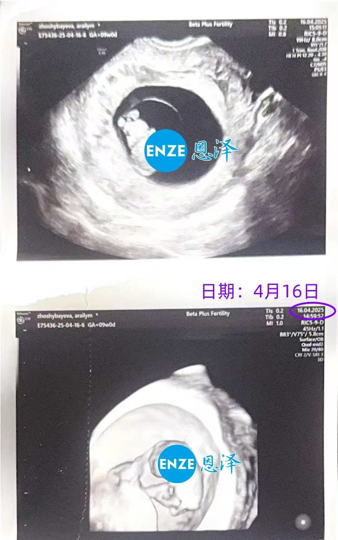 格鲁吉亚代孕代孕代母首次产检顺利过关