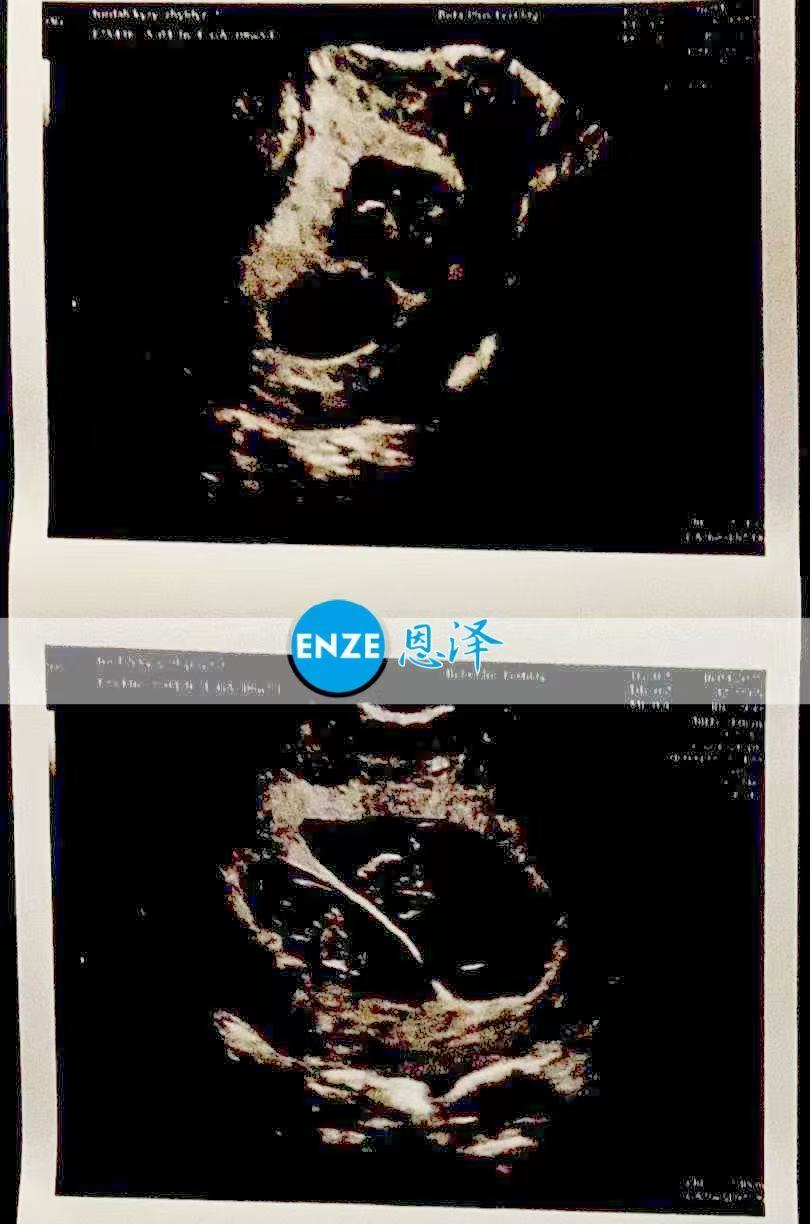 格鲁吉亚代孕代孕代母8周产检顺利通过