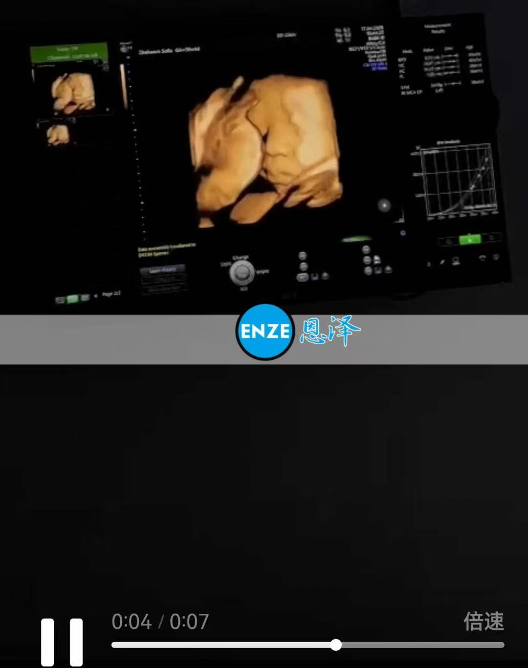 格鲁吉亚代孕代孕代母38周产检顺利，安心待产
