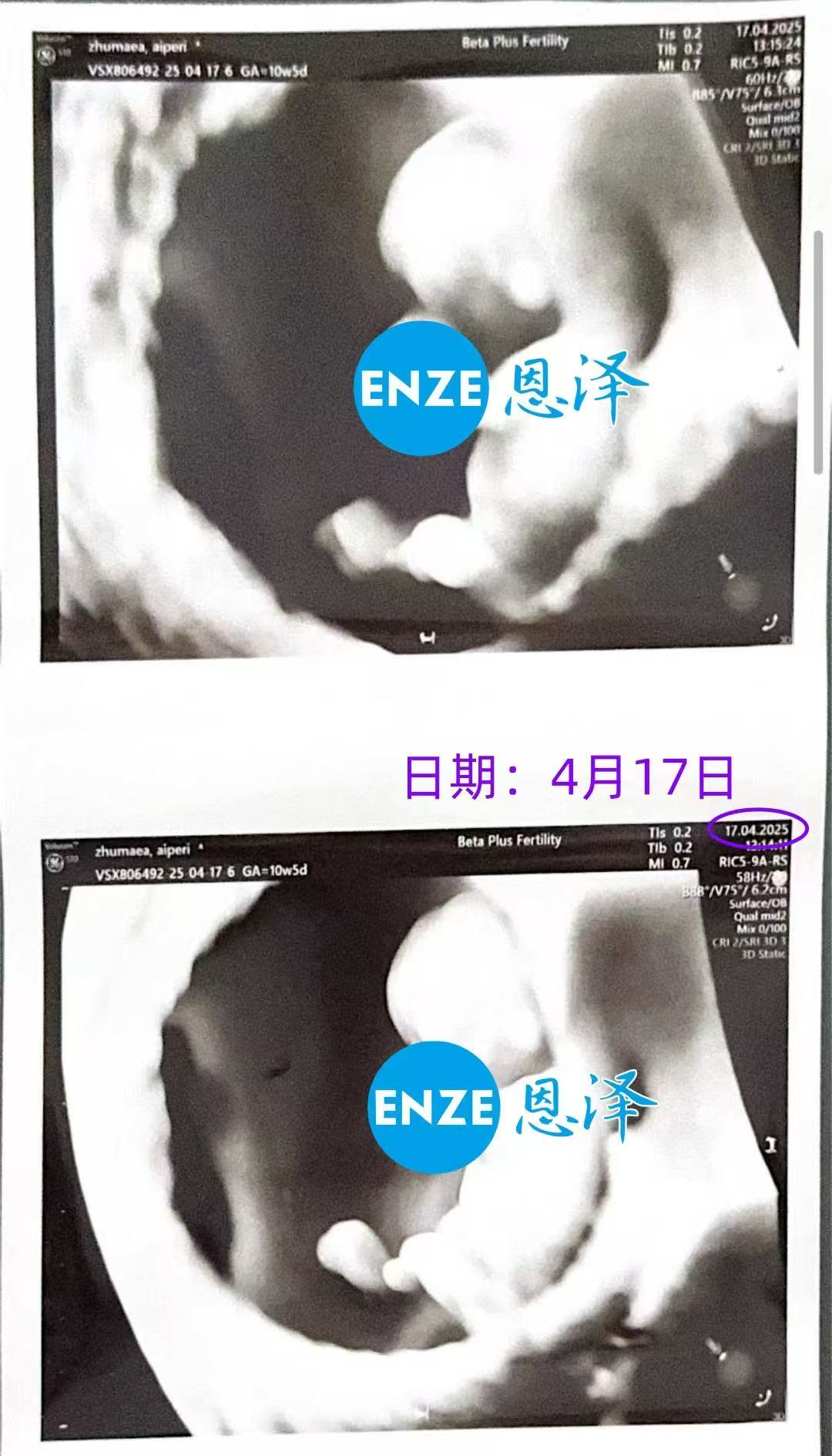 格鲁吉亚代孕代孕代母10周产检顺利过关
