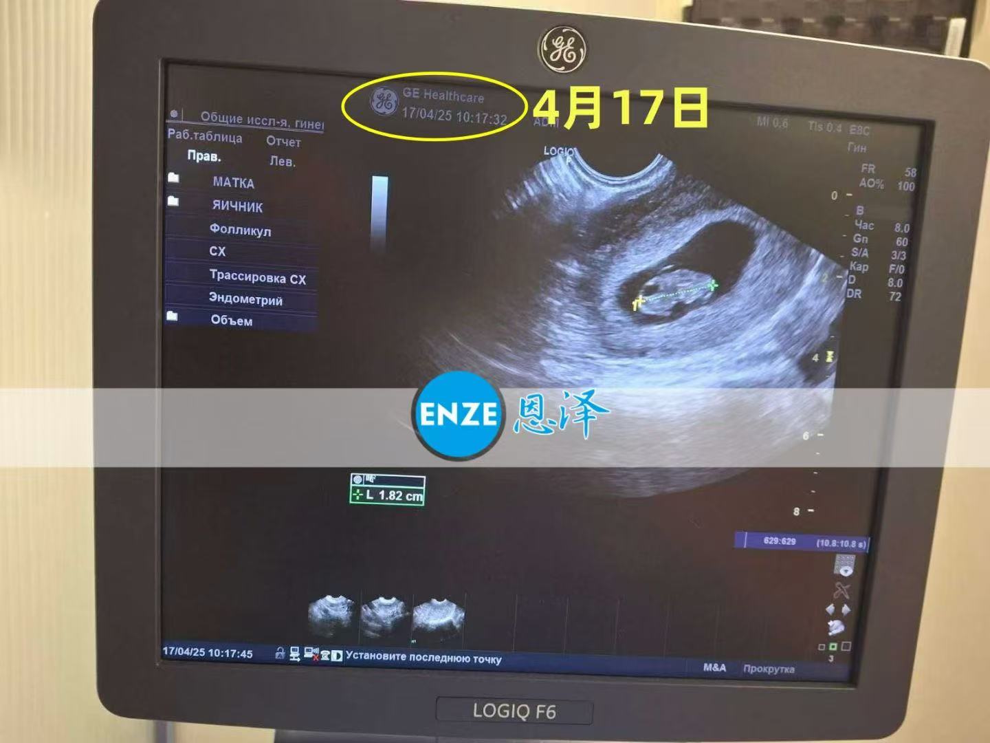 乌克兰代孕代孕代母8周产检顺利通过