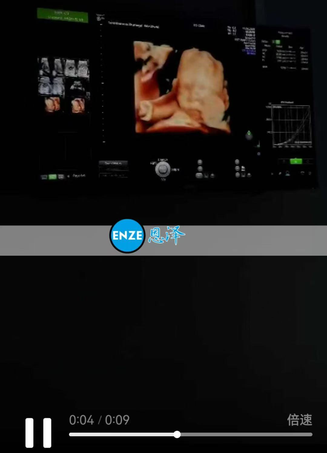 格鲁吉亚代孕代孕代母双胎22周产检顺利通过