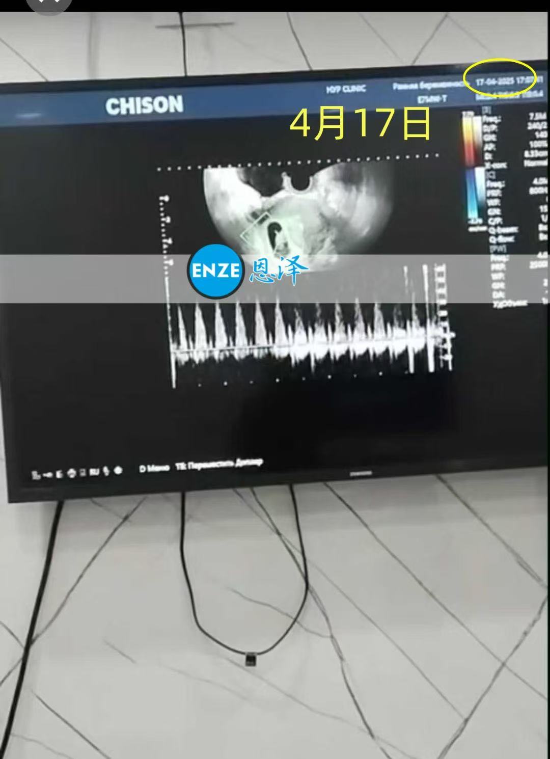 格鲁吉亚代孕代孕代母8周产检顺利过关