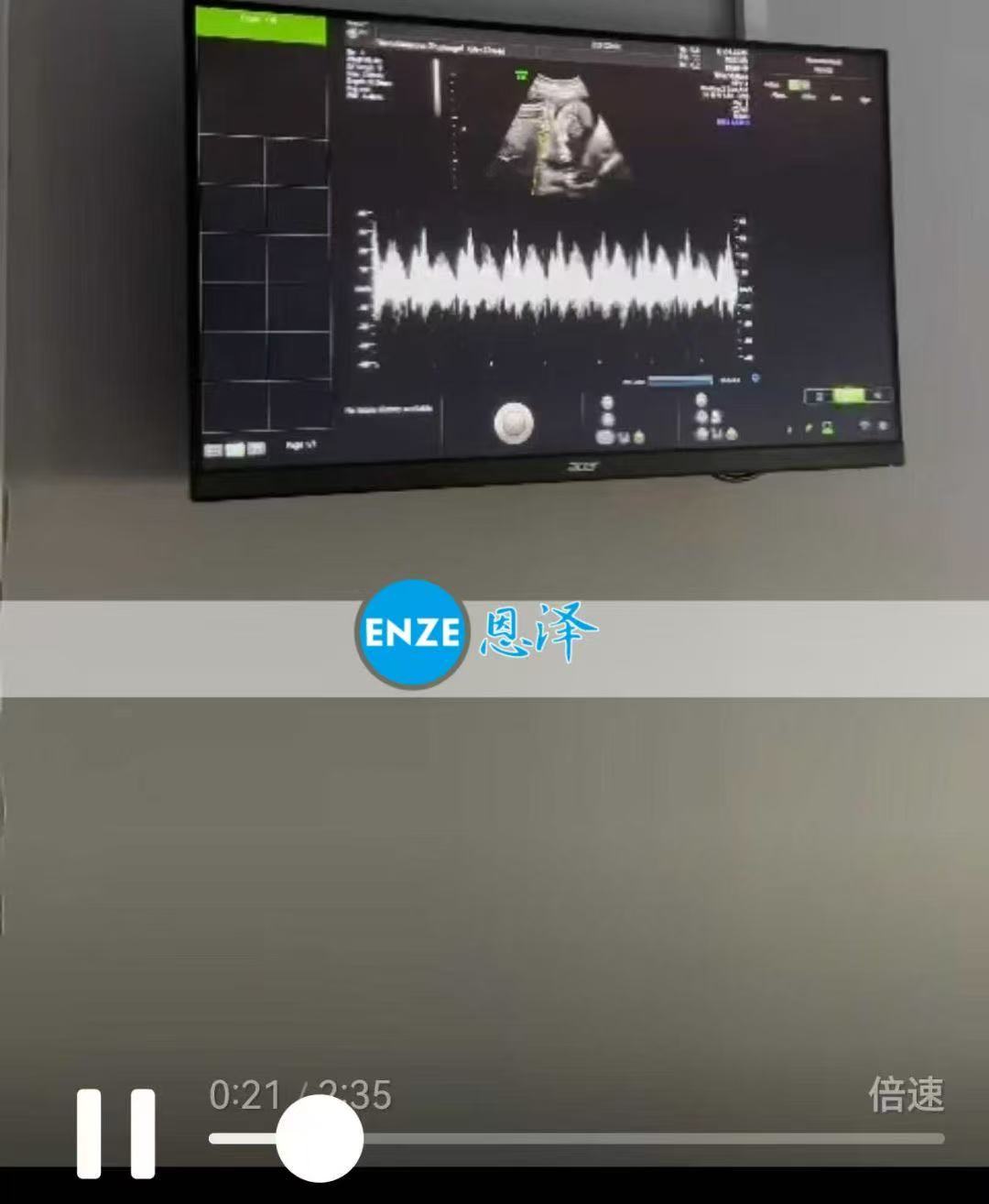 格鲁吉亚代孕代孕代母双胎22周产检顺利通过