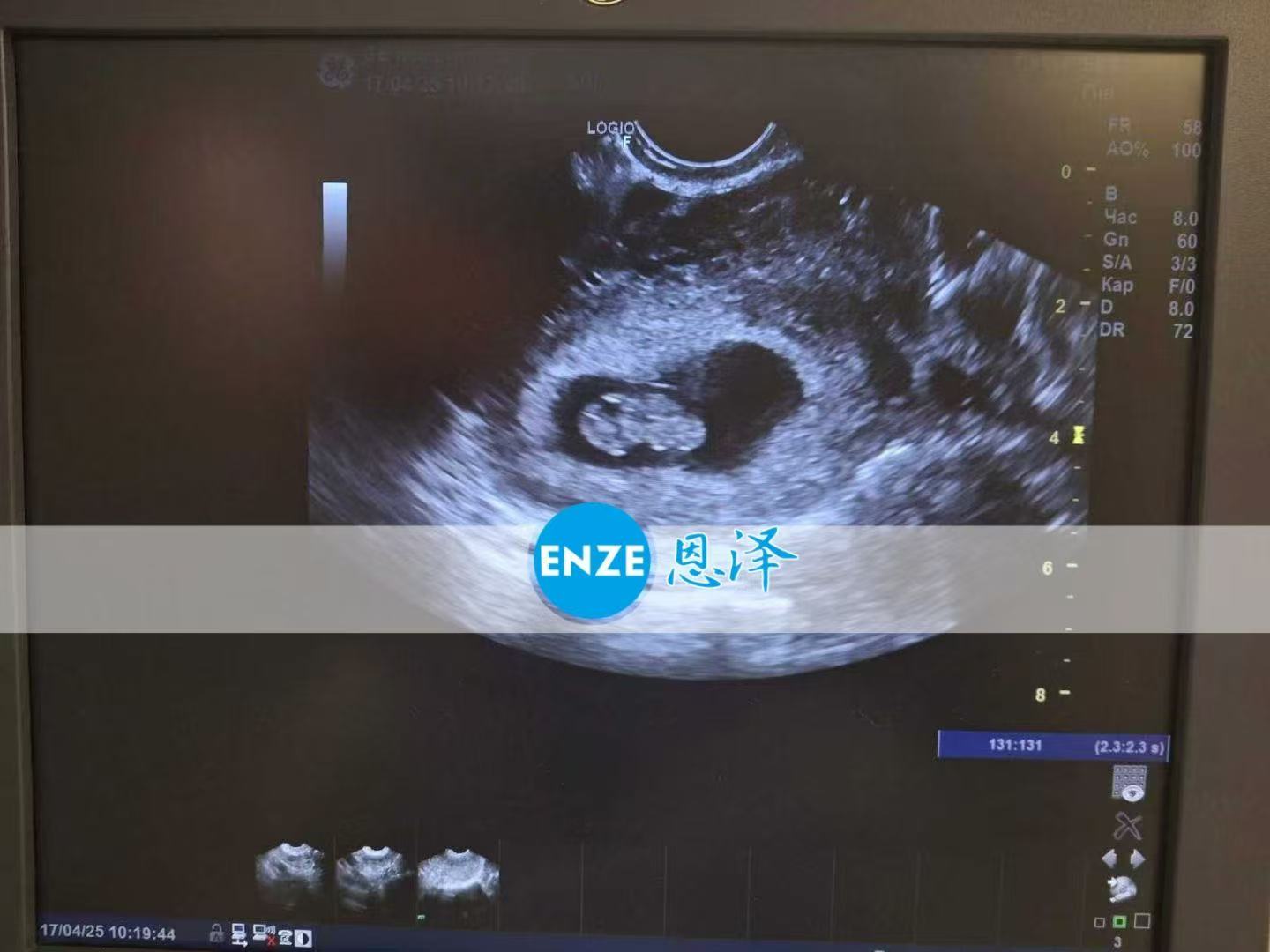 乌克兰代孕代孕代母8周产检顺利通过