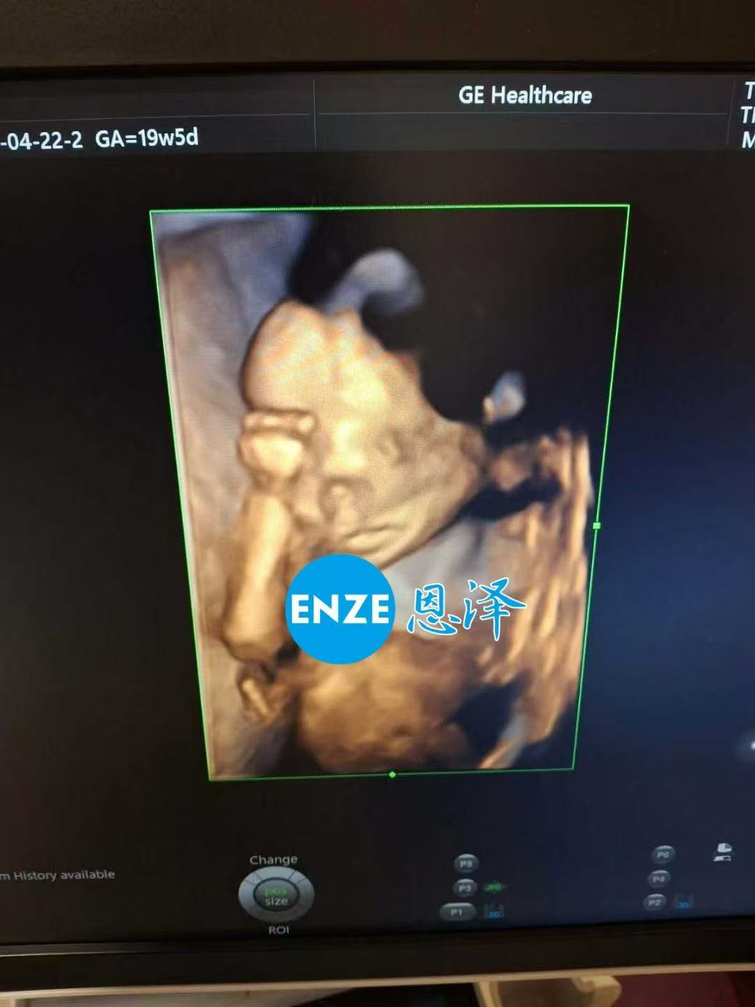 乌克兰代孕代孕代母19周产检顺利通过