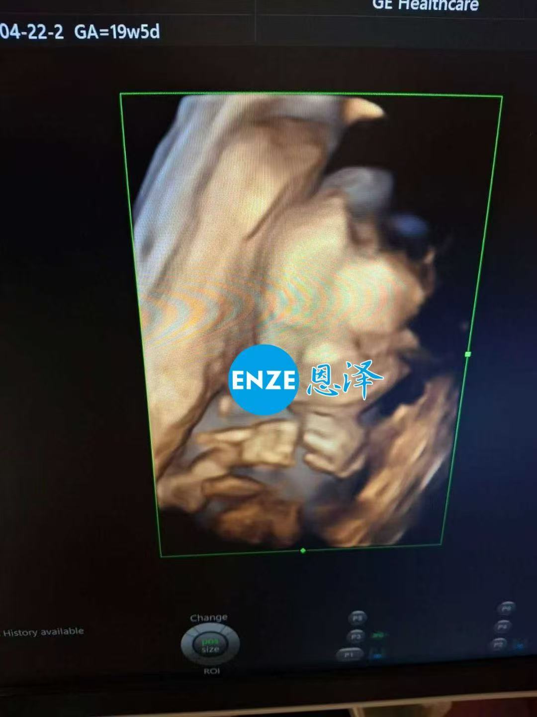 乌克兰代孕代孕代母19周产检顺利通过