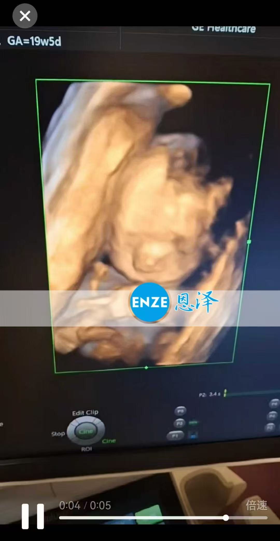 乌克兰代孕代孕代母19周产检顺利通过