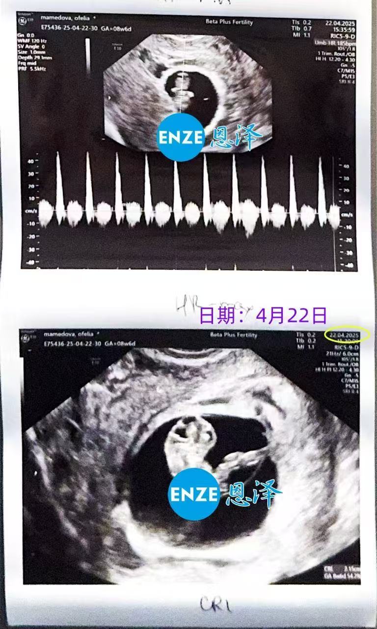 格鲁吉亚代孕代孕代母8周产检顺利过关