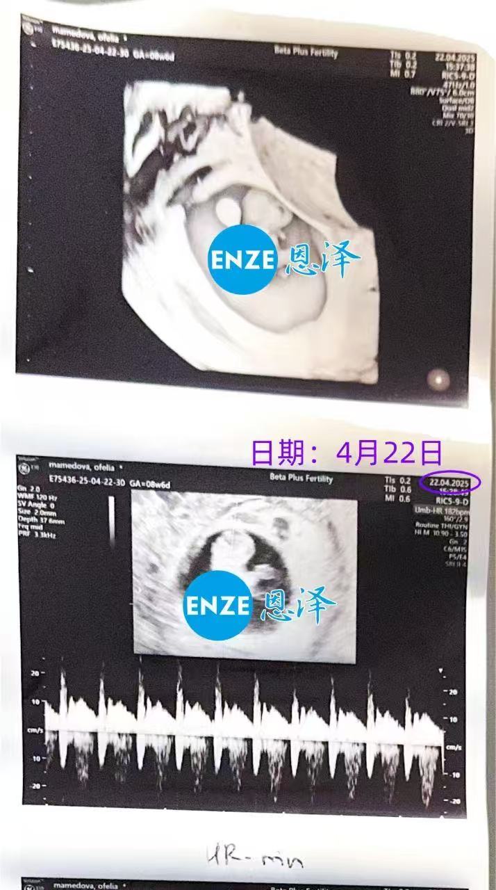 格鲁吉亚代孕代孕代母8周产检顺利过关