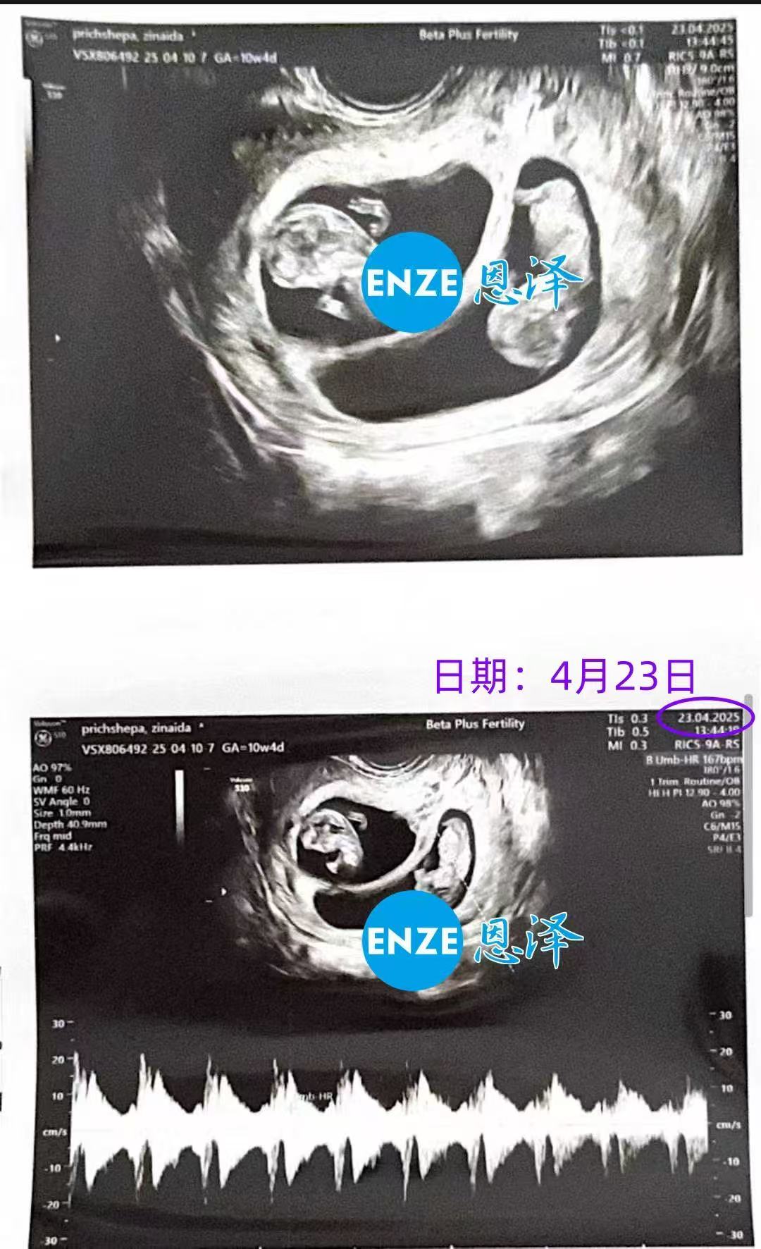 格鲁吉亚代孕双胎代孕代母通过10周产检