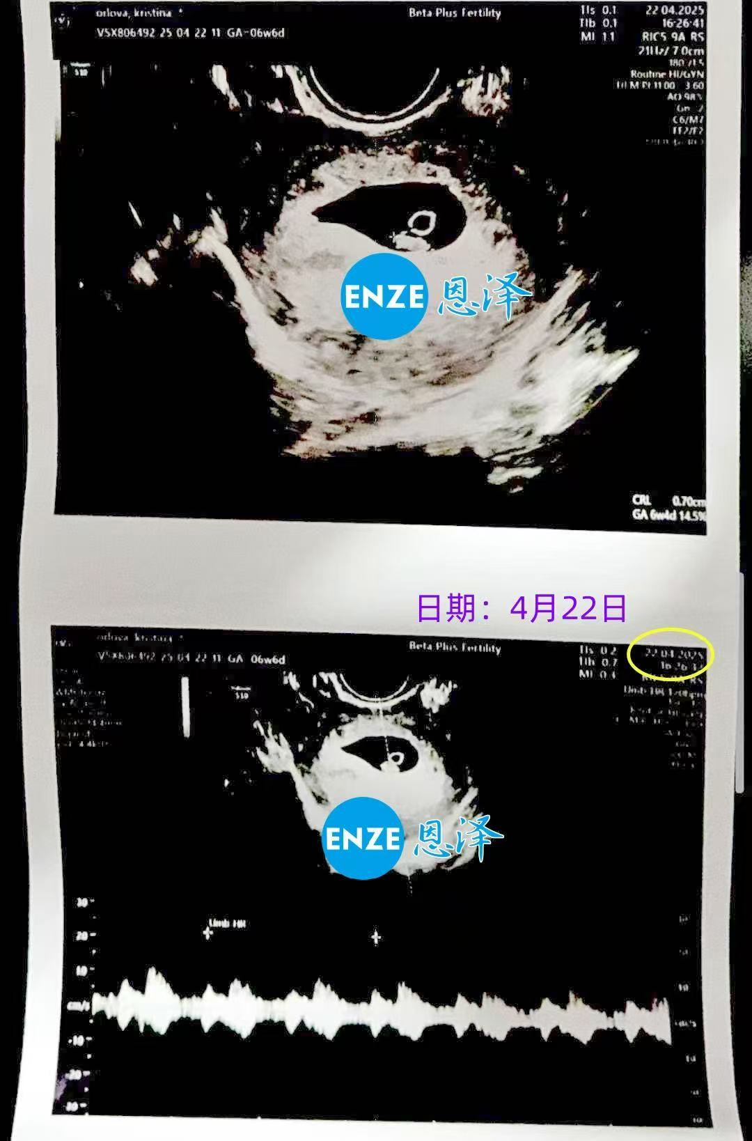 格鲁吉亚代孕代孕代母首检确认双胎报到