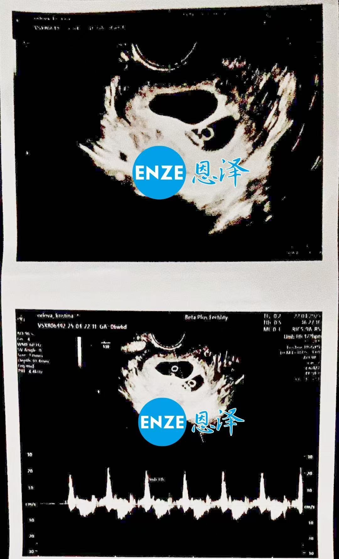 格鲁吉亚代孕代孕代母首检确认双胎报到