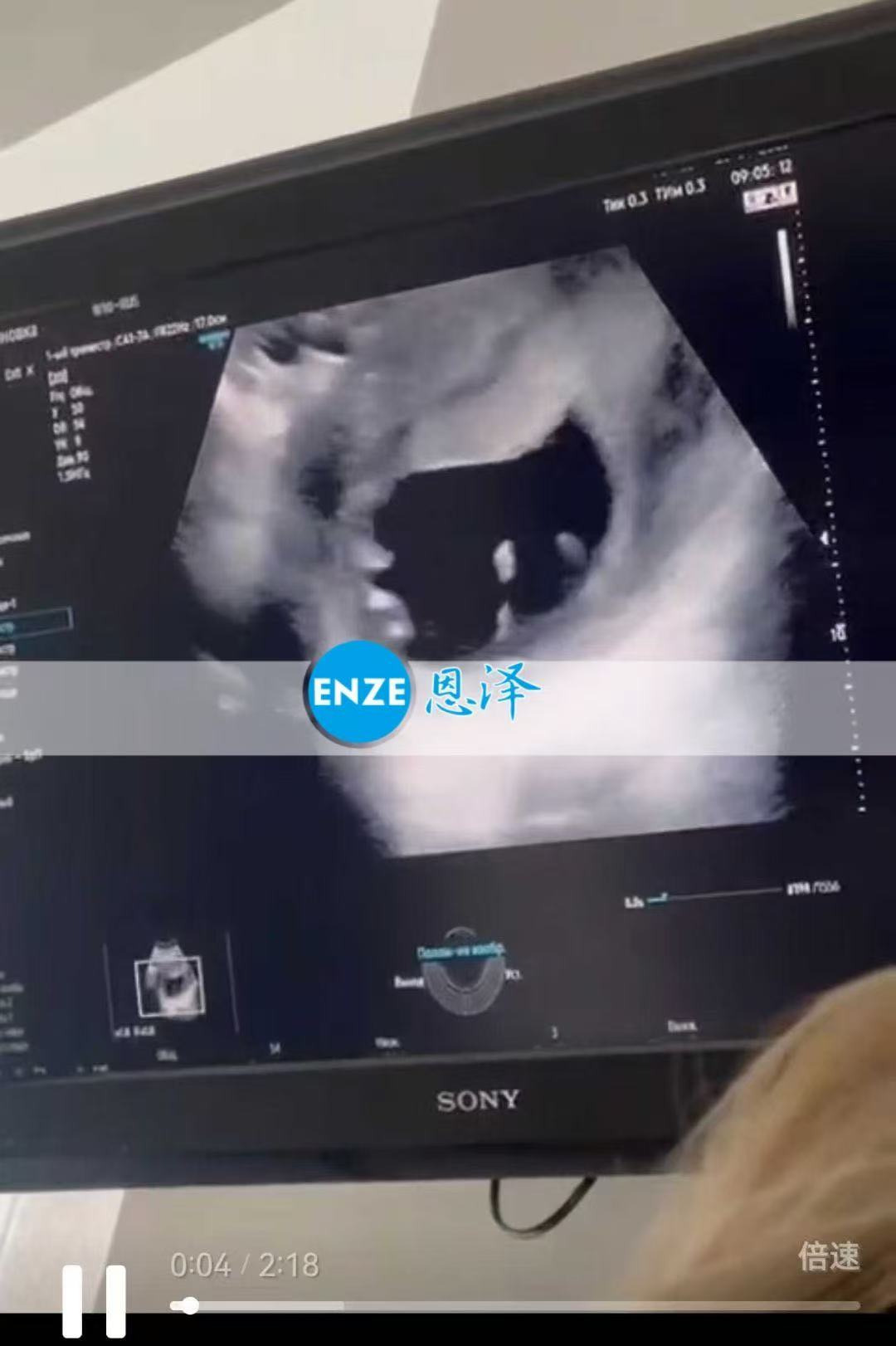 哈萨克斯坦代孕代孕代母12周产检顺利过关