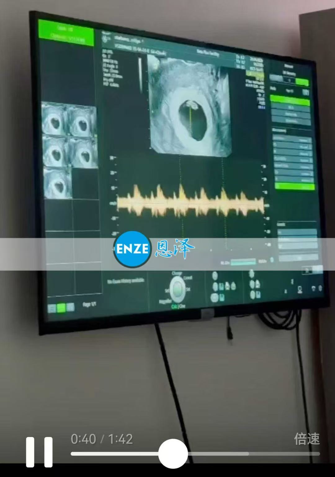 格鲁吉亚代孕代孕代母6周首检顺利通过