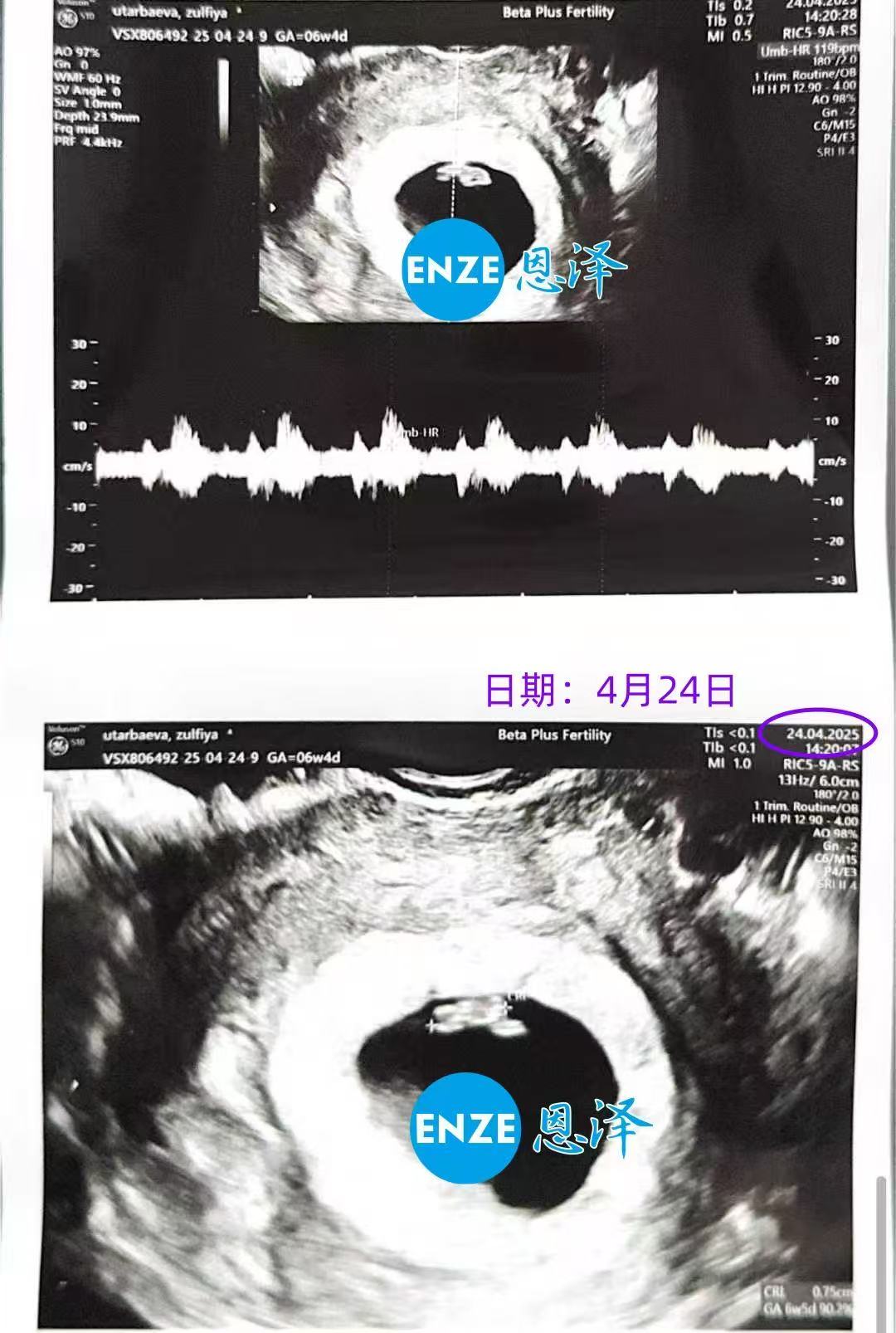 格鲁吉亚代孕代孕代母6周首检顺利通过