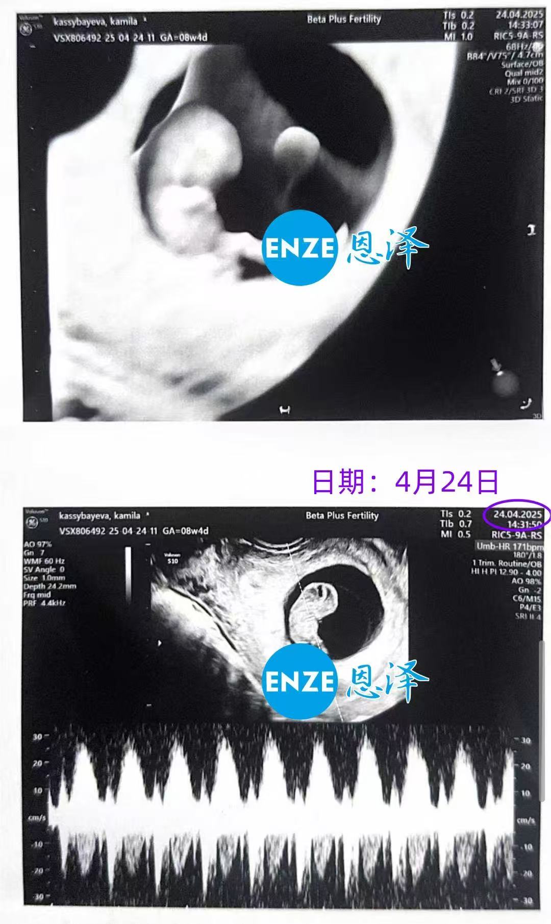 格鲁吉亚代孕代孕代母8周产检顺利通过
