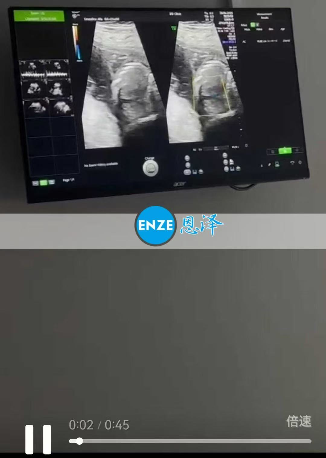 格鲁吉亚代孕双胎代孕代母21周产检过关