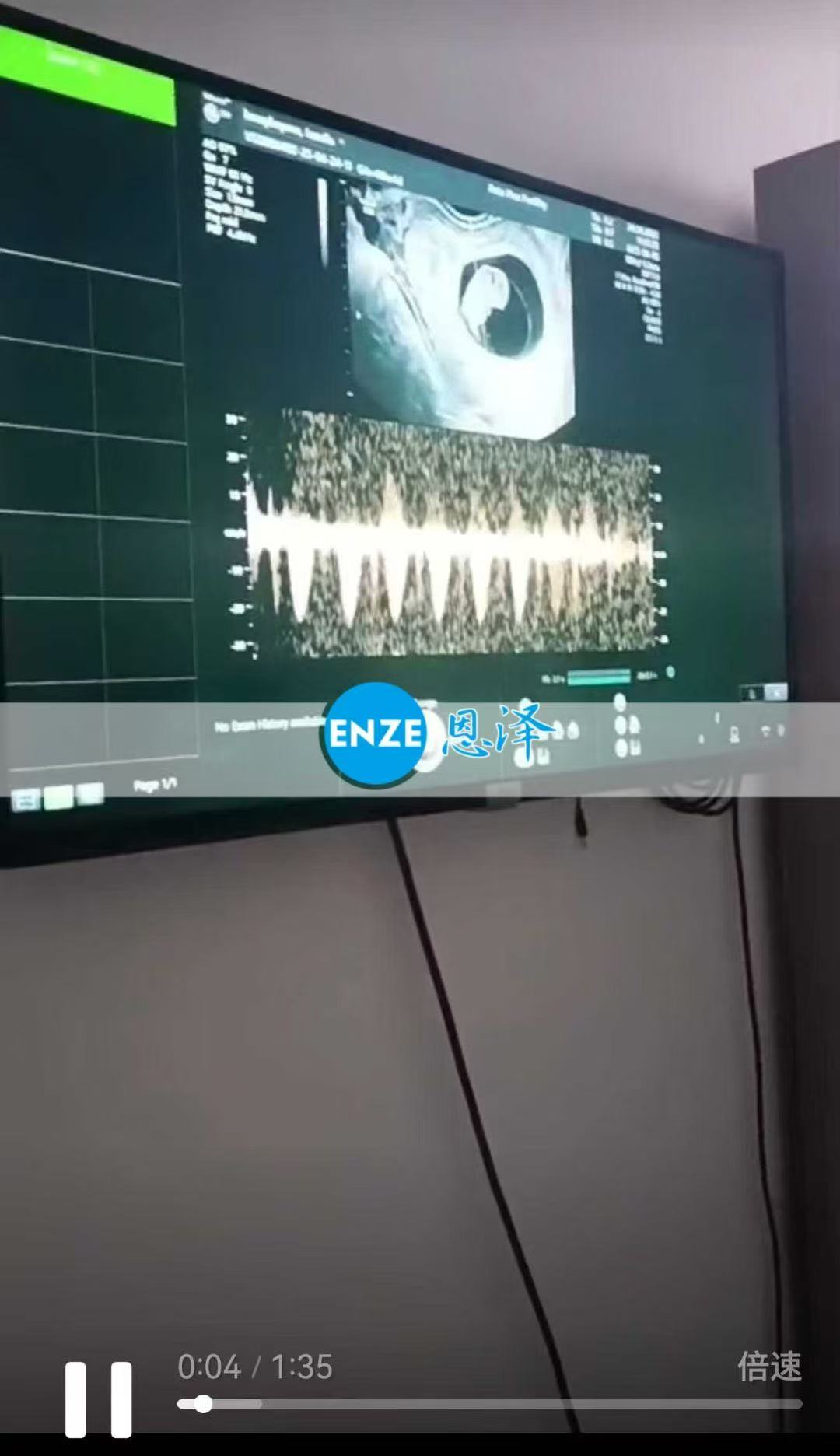 格鲁吉亚代孕代孕代母8周产检顺利通过
