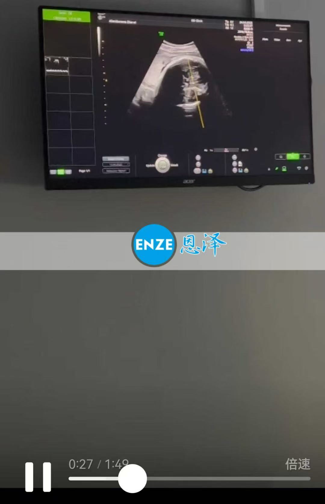 格鲁吉亚代孕代孕代母35周产检顺利过关