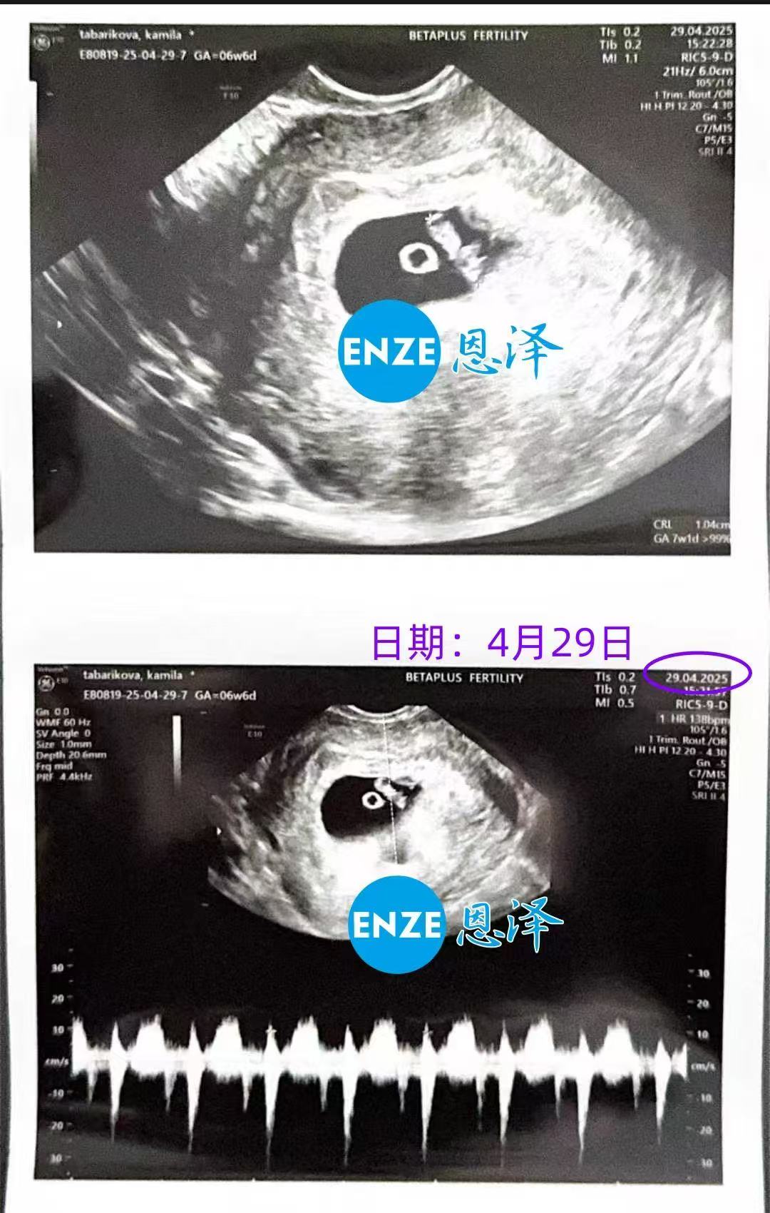 格鲁吉亚代孕代孕代母6周首检顺利过关