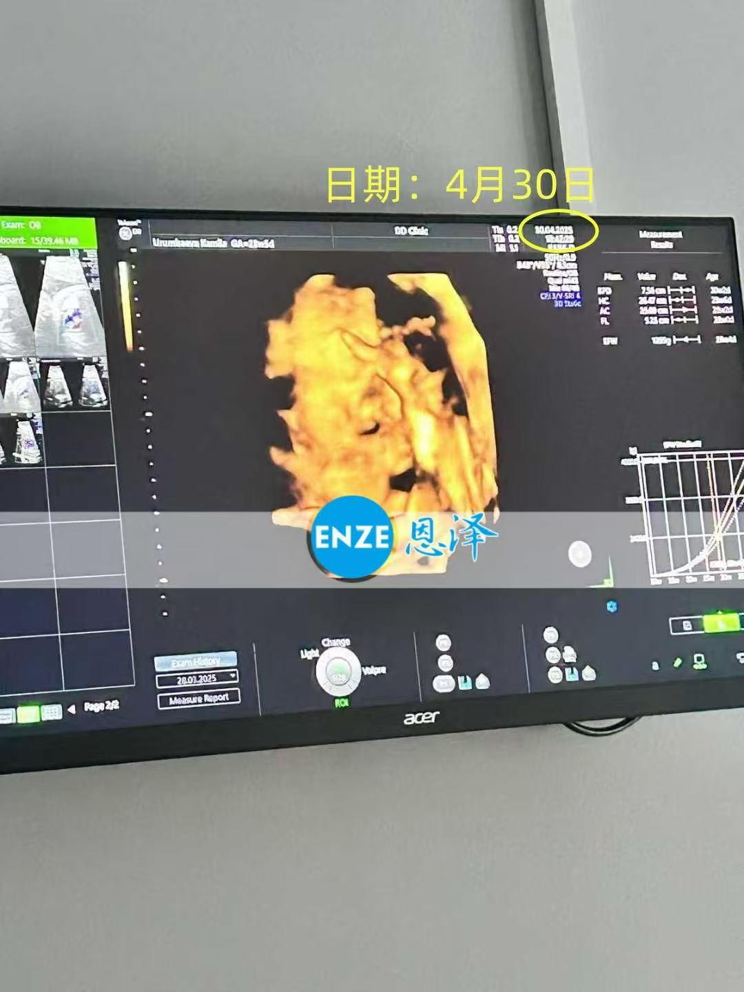 格鲁吉亚代孕代孕代母28周产检顺利过关