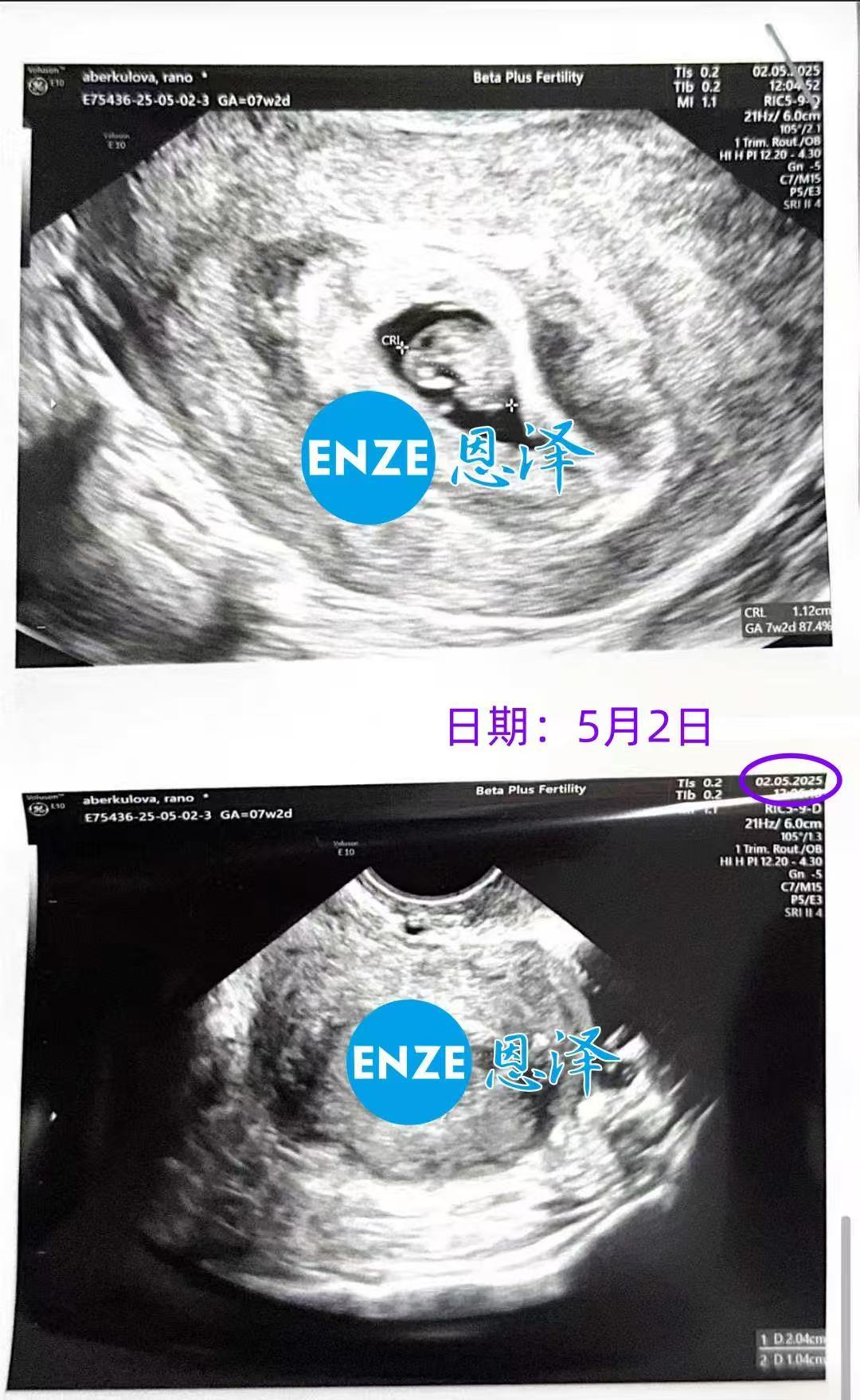 格鲁吉亚代孕代孕代母7周产检顺利通过