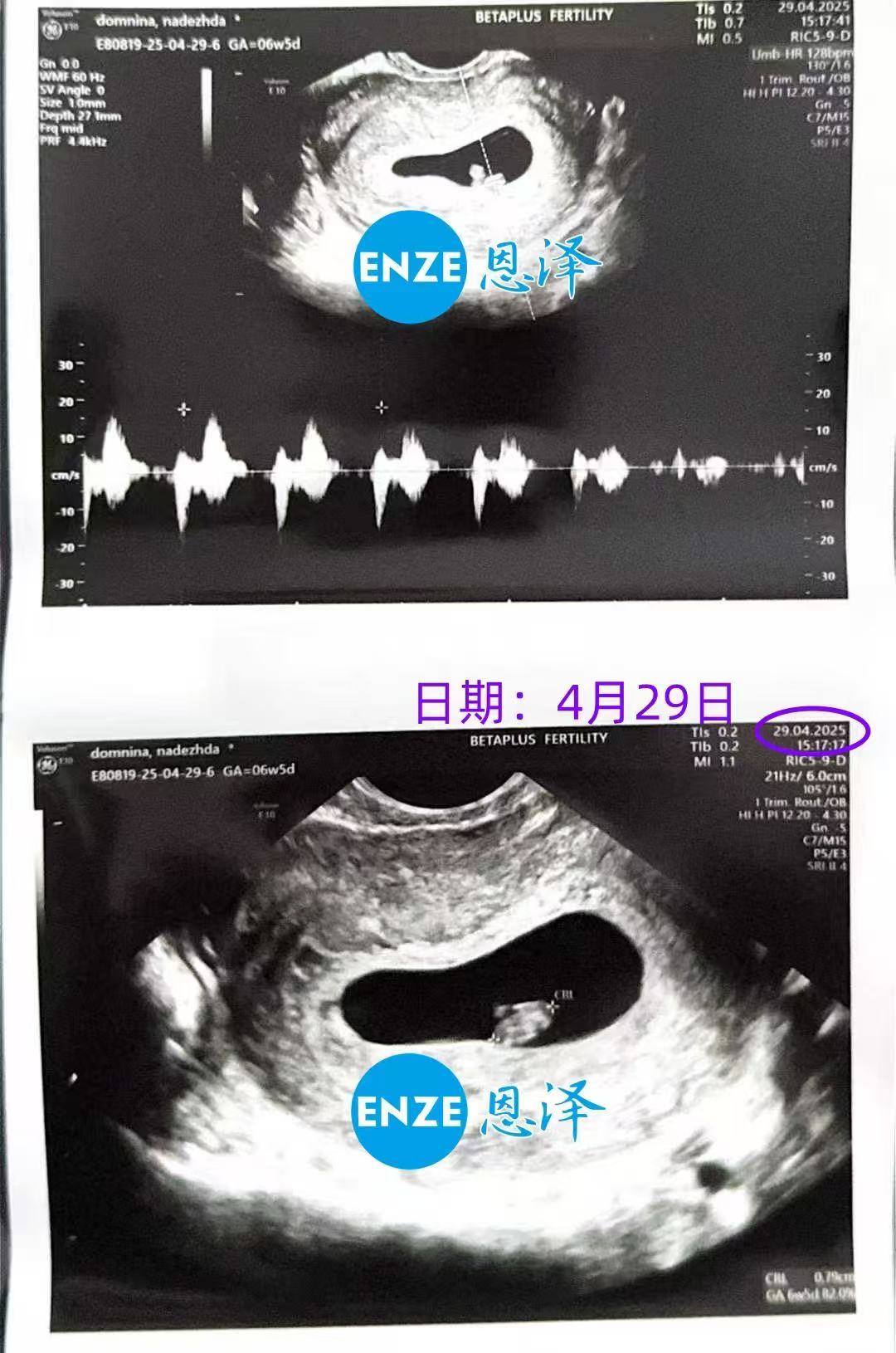 格鲁吉亚代孕代孕代母首次产检顺利通过