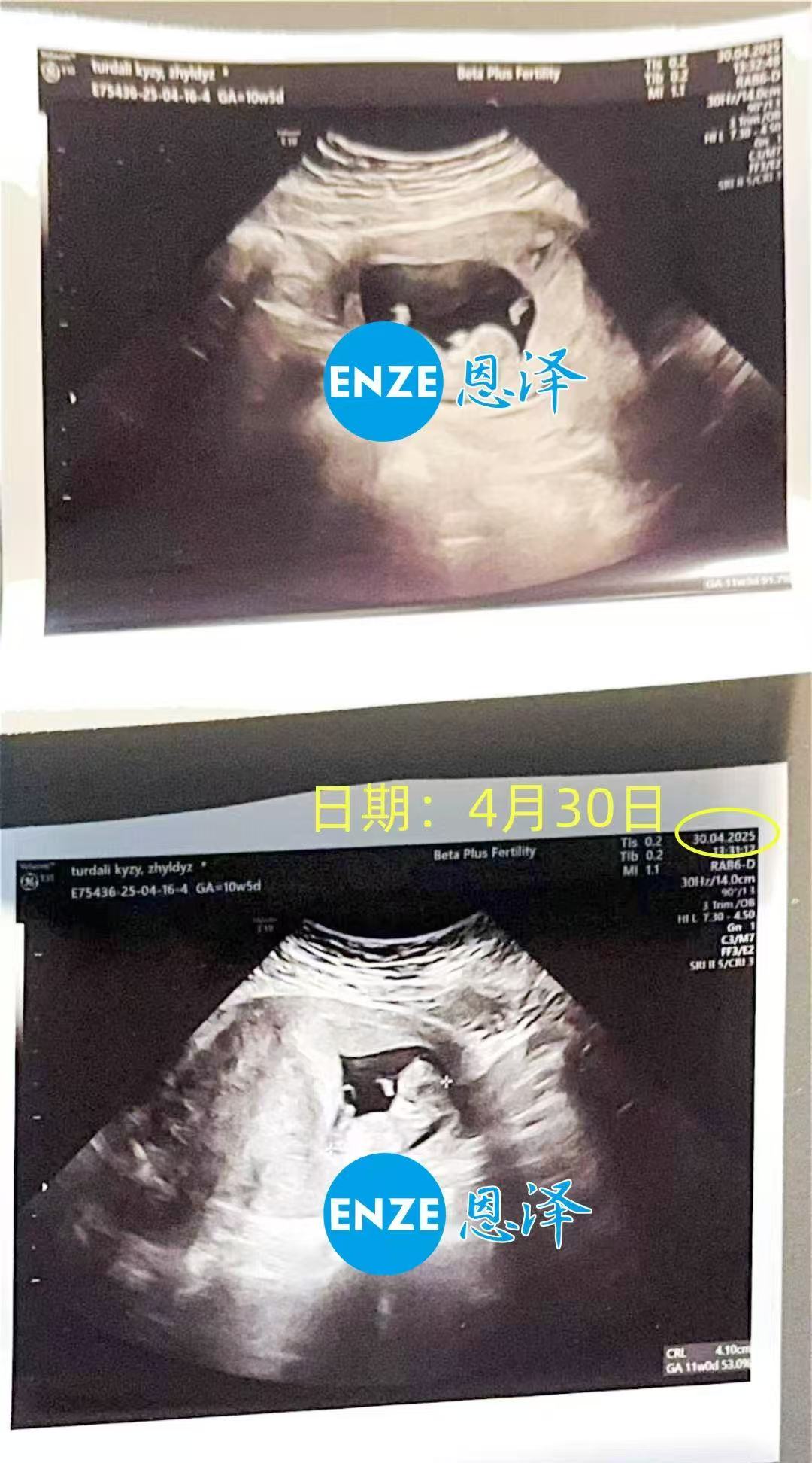 格鲁吉亚代孕代孕代母成功通过10周产检