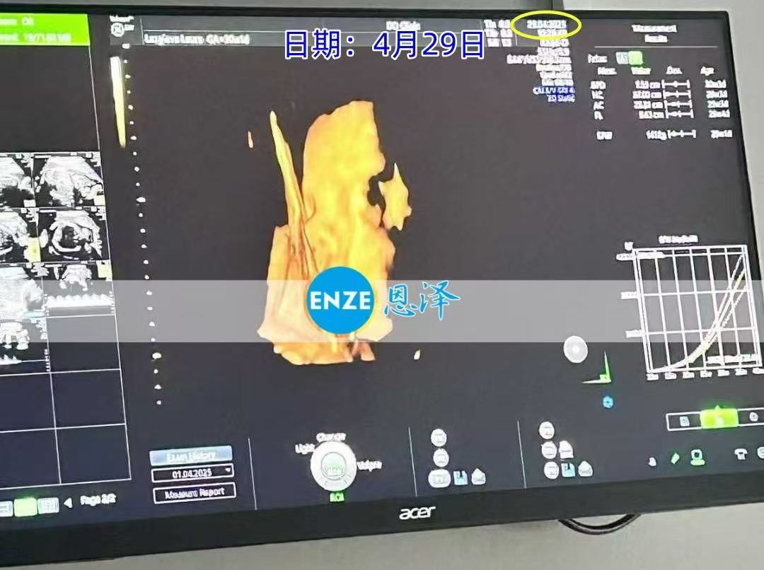 格鲁吉亚代孕代孕代母30周产检顺利通过