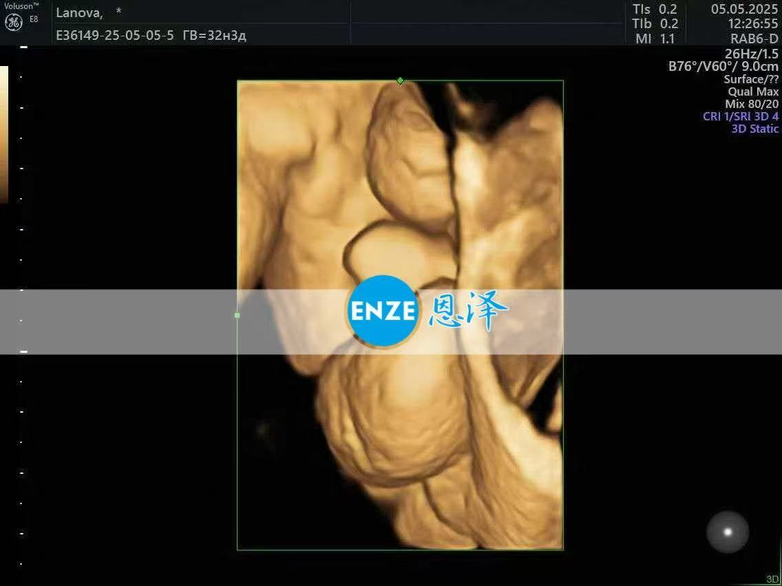 格鲁吉亚代孕代孕代母32周产检顺利通过