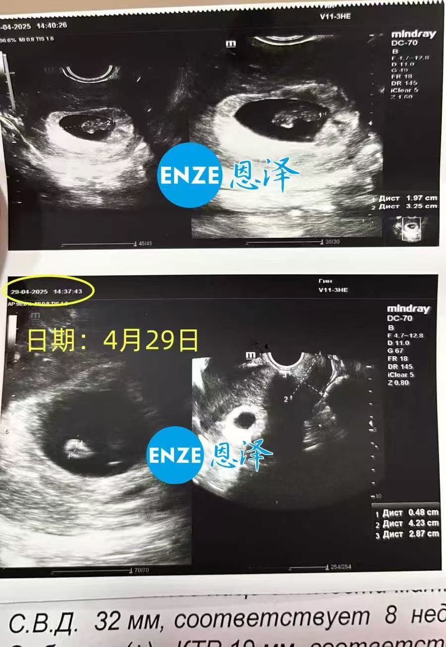 格鲁吉亚代孕代孕代母8周产检顺利过关