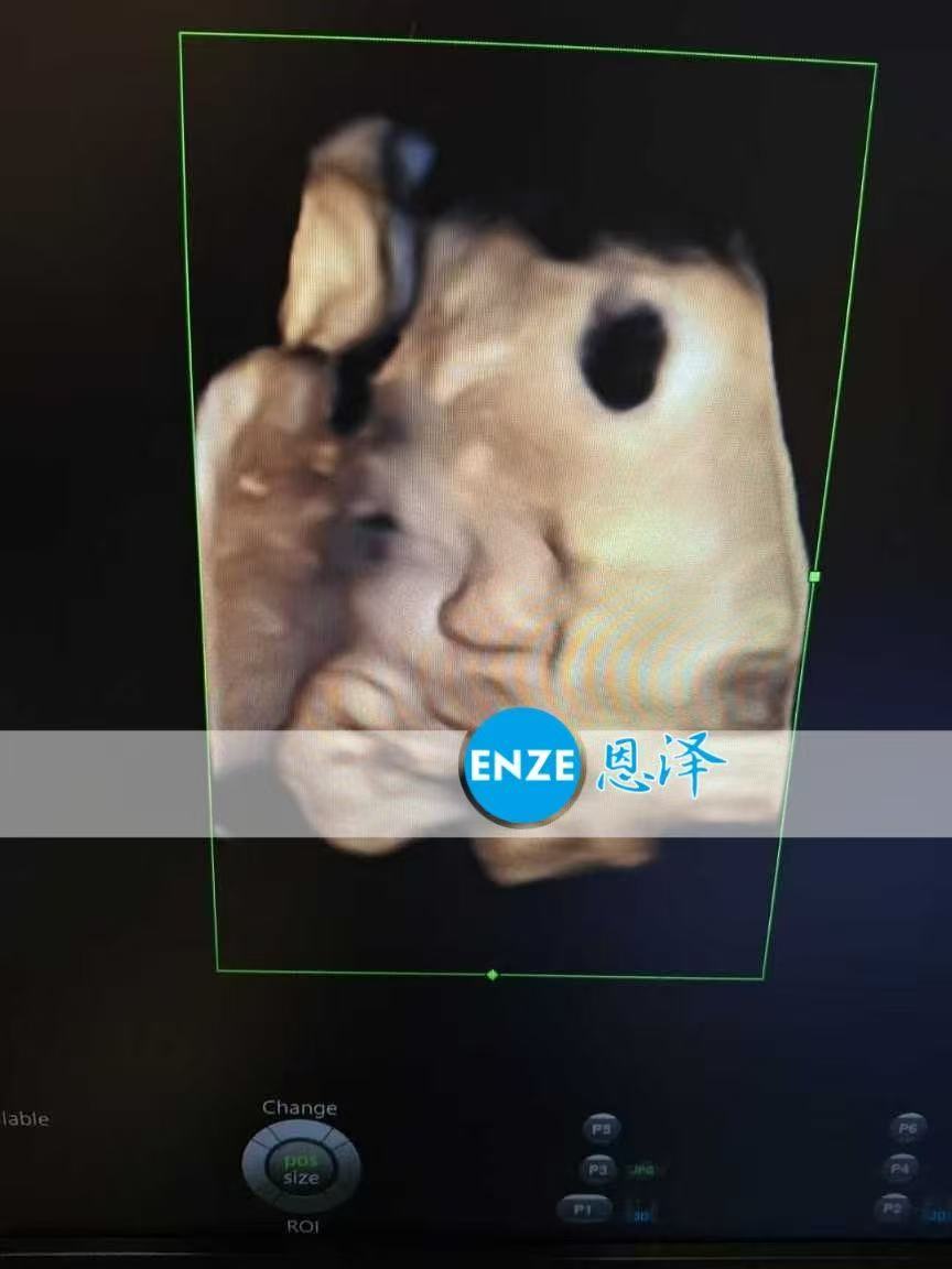 乌克兰代孕代孕代母产检顺利，静待宝贝降生