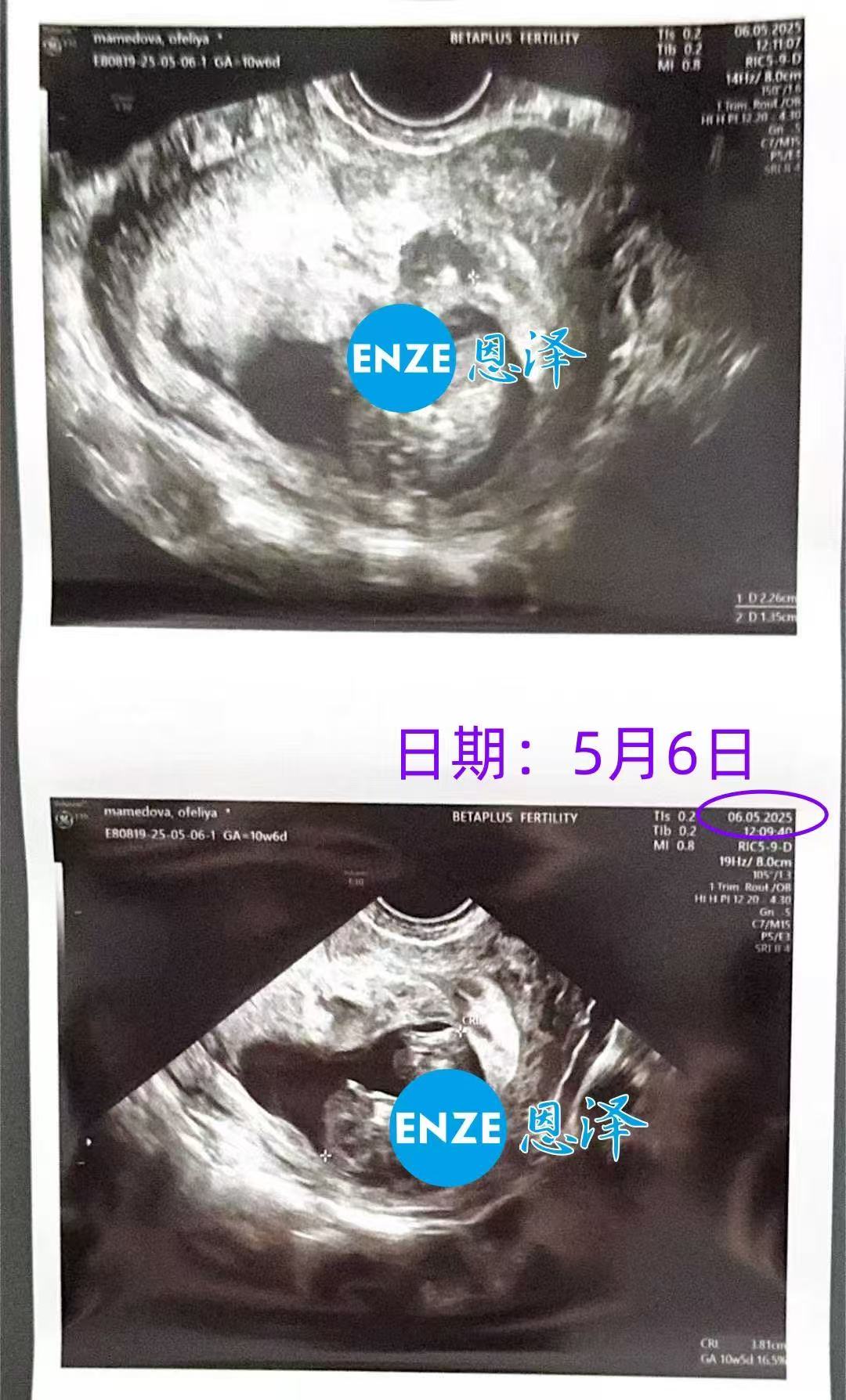 格鲁吉亚代孕代孕代母10周产检顺利通过