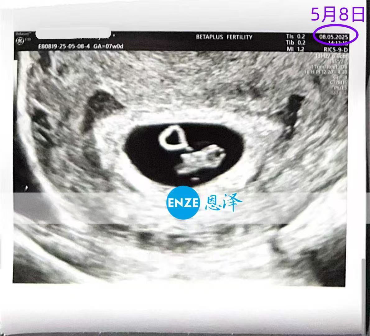 格鲁吉亚代孕代孕代母成功通过7周产检