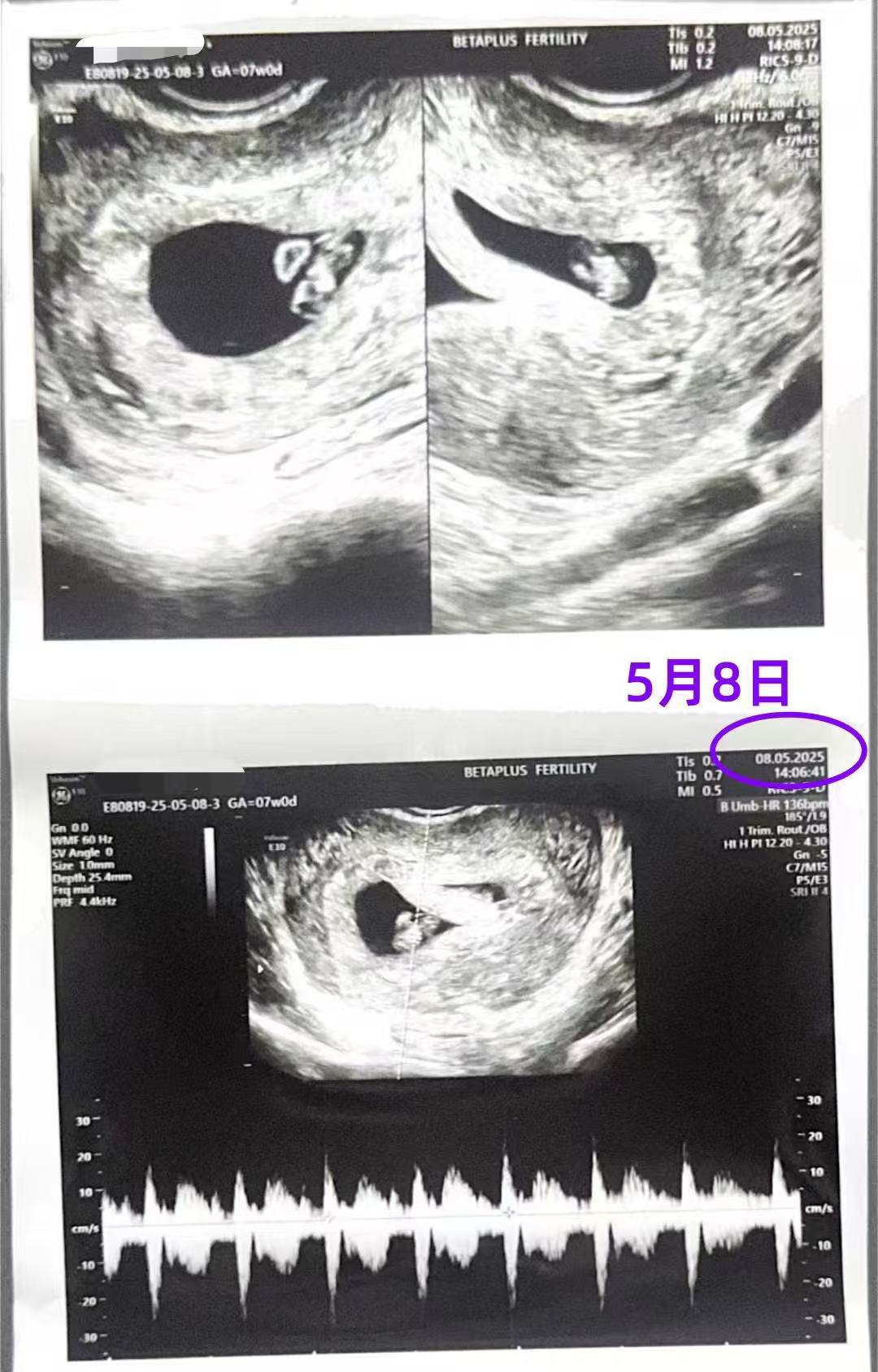 格鲁吉亚代孕代孕代母7周产检顺利通过