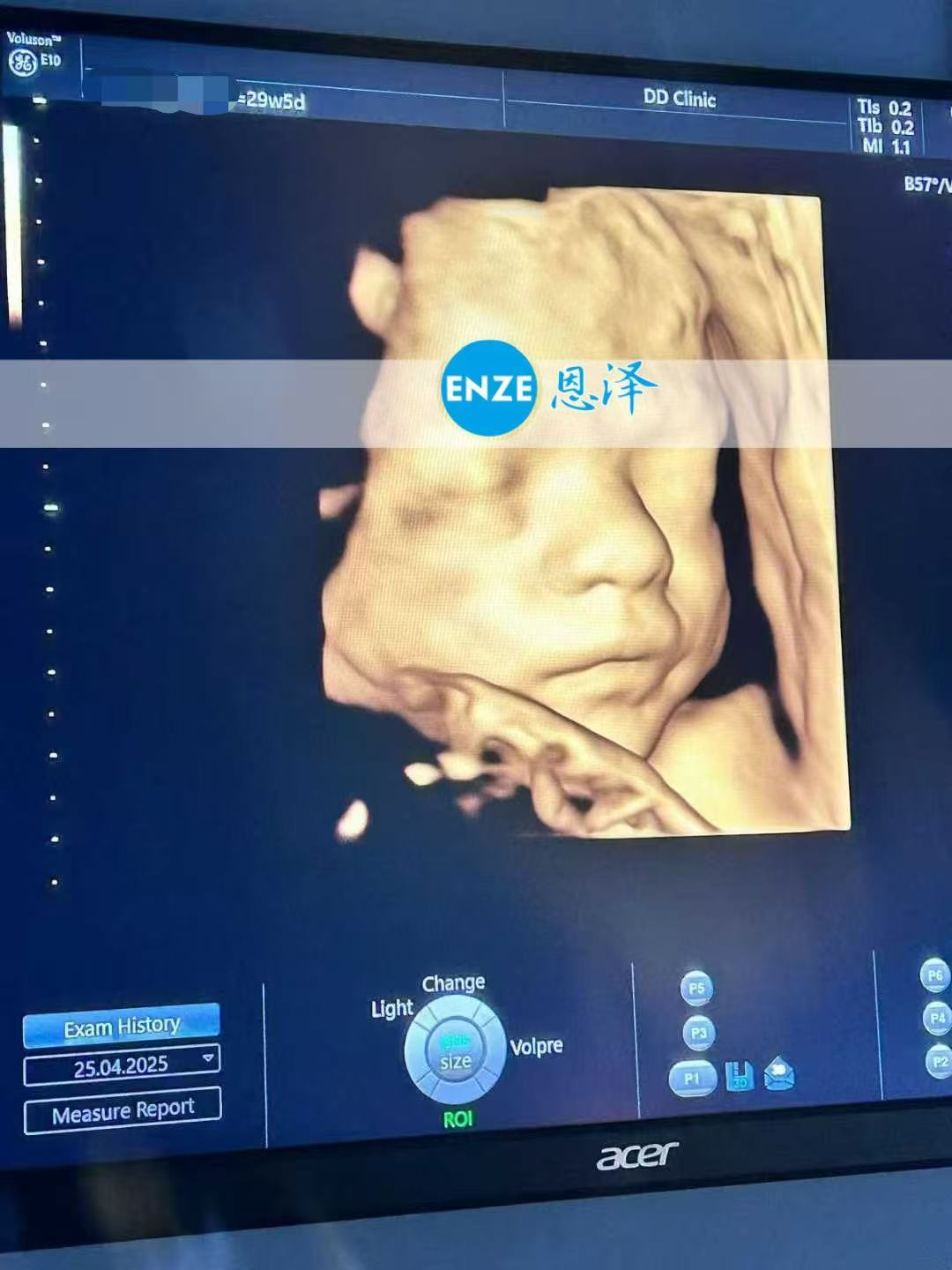 格鲁吉亚代孕代孕代母29周产检顺利通过