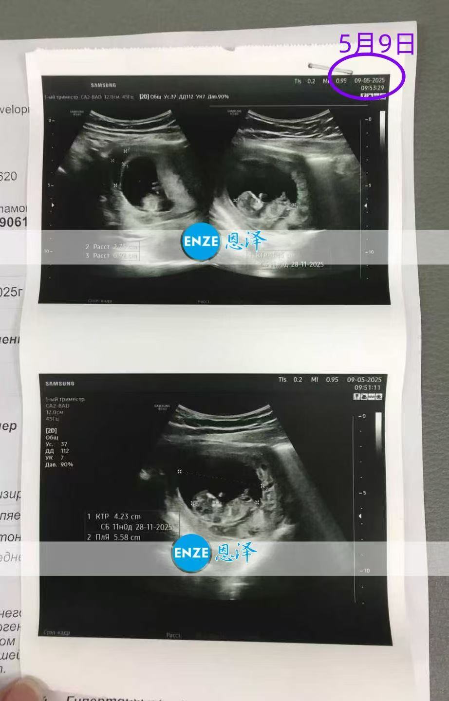 格鲁吉亚代孕代孕代母11周产检顺利通过
