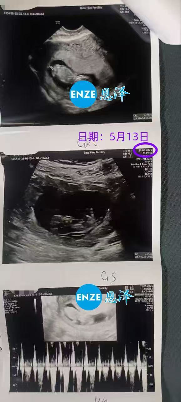 格鲁吉亚代孕代孕代母10周产检顺利通过