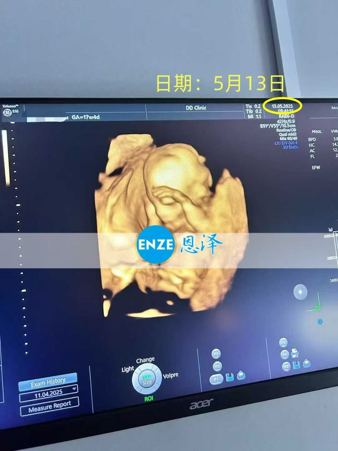 格鲁吉亚代孕代孕代母17周产检顺利通过