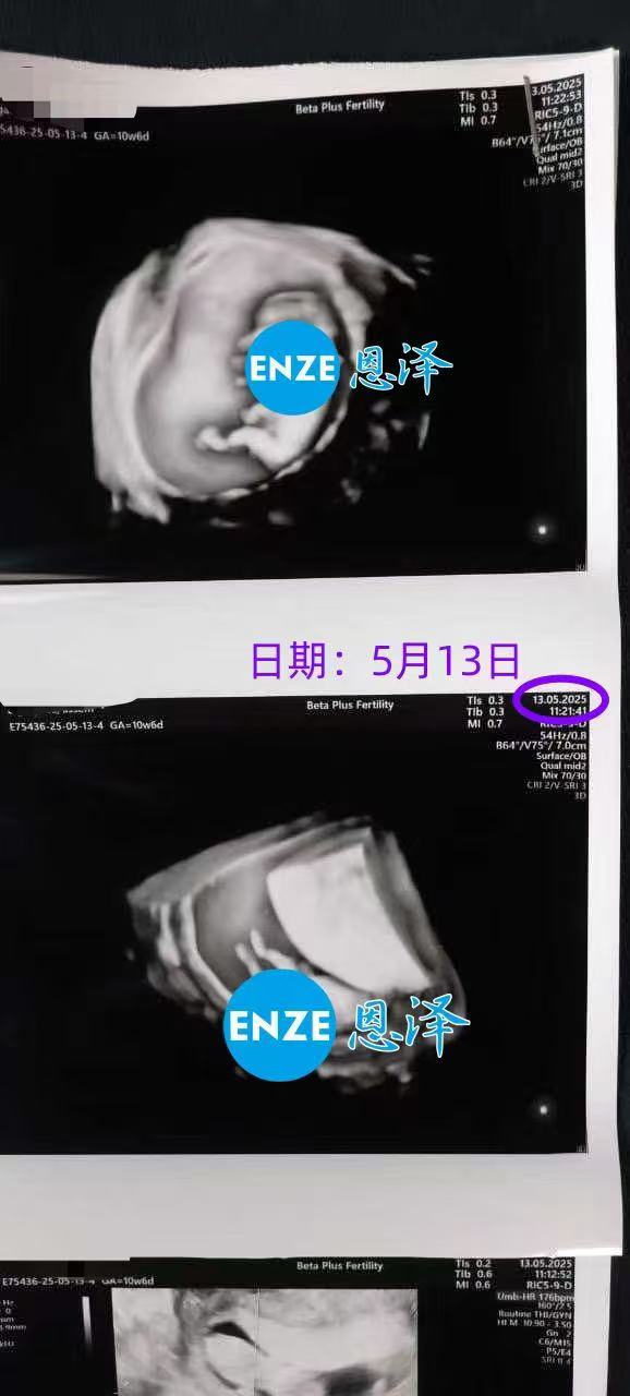 格鲁吉亚代孕代孕代母10周产检顺利通过