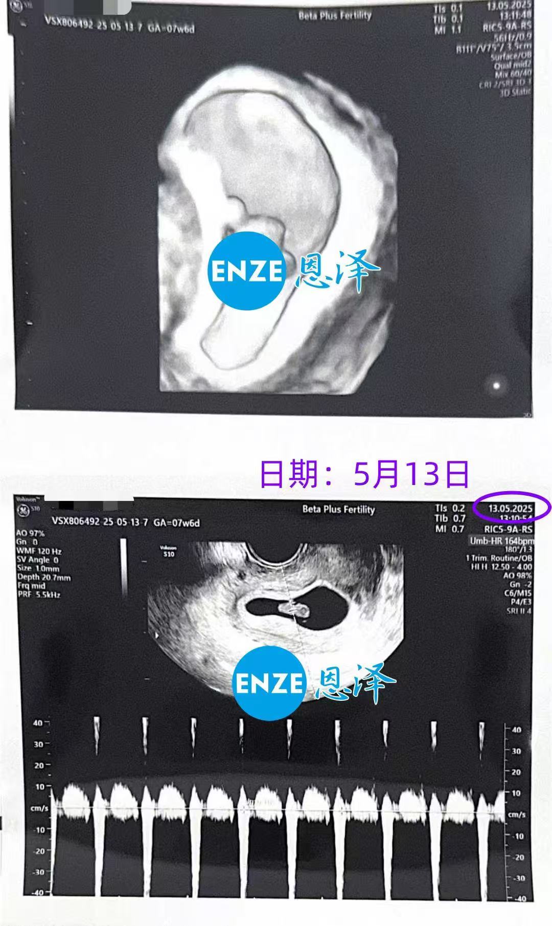 格鲁吉亚代孕代孕代母7周产检顺利过关