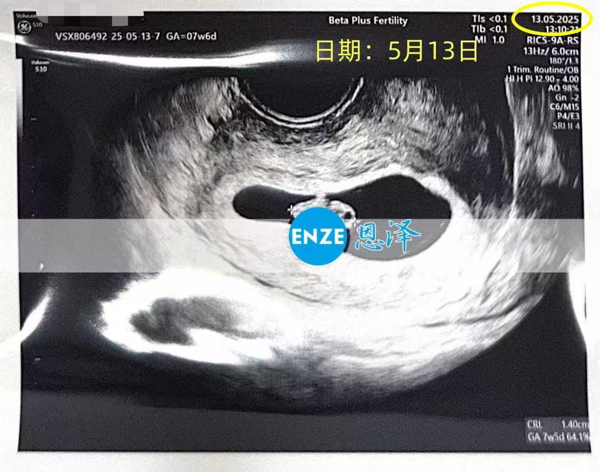 格鲁吉亚代孕代孕代母7周产检顺利过关