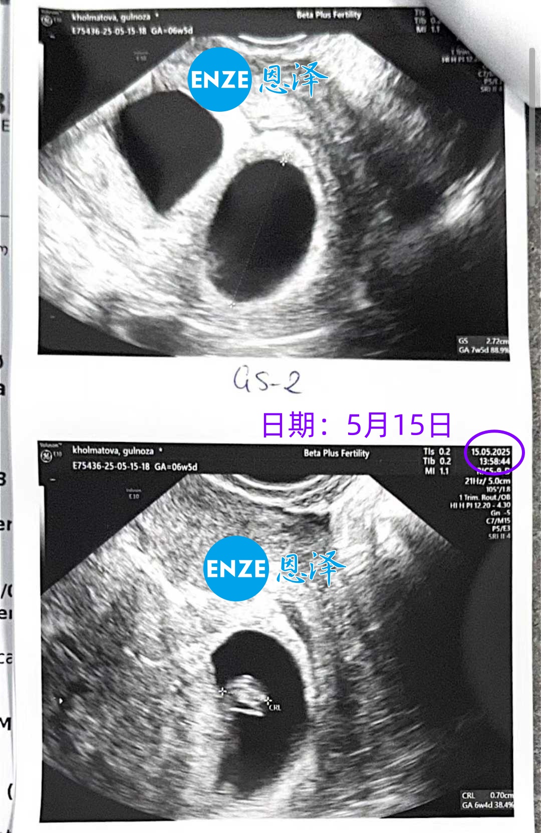 恩泽格鲁吉亚代孕代母6周检查顺利通过