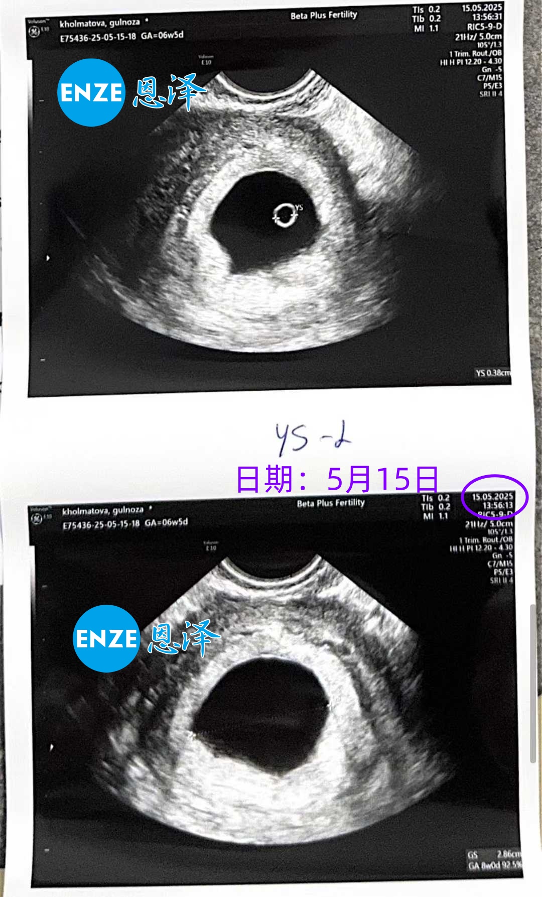 恩泽格鲁吉亚代孕代母6周检查顺利通过