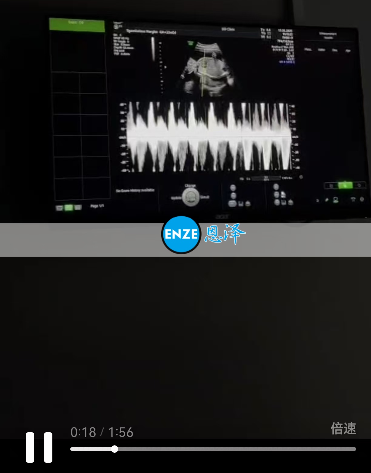 恩泽格鲁吉亚代孕代母23周检查顺利通过