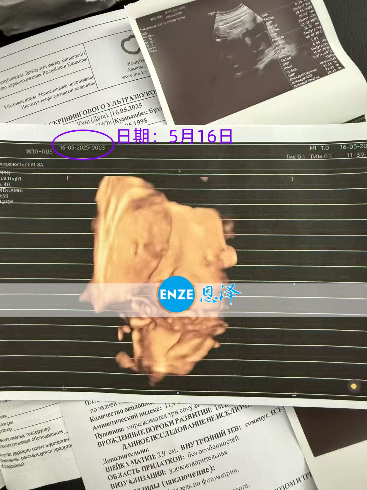 恩泽格鲁吉亚代孕代母32周检查顺利通过