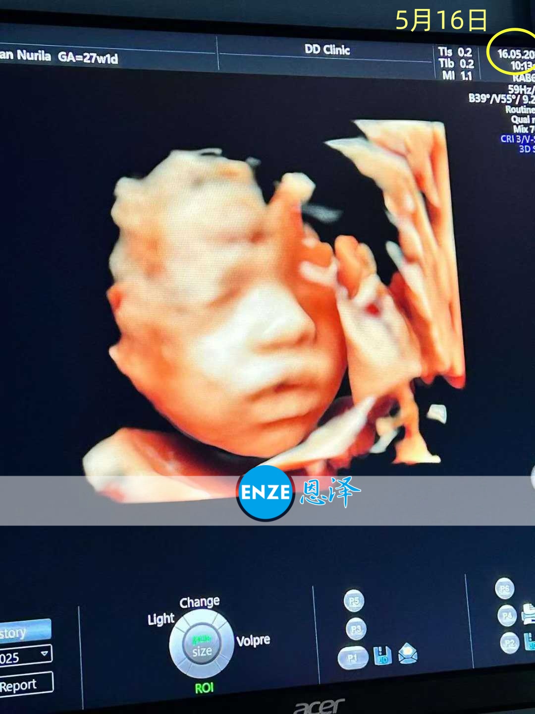 恩泽格鲁吉亚代孕代母27周产检顺利通过