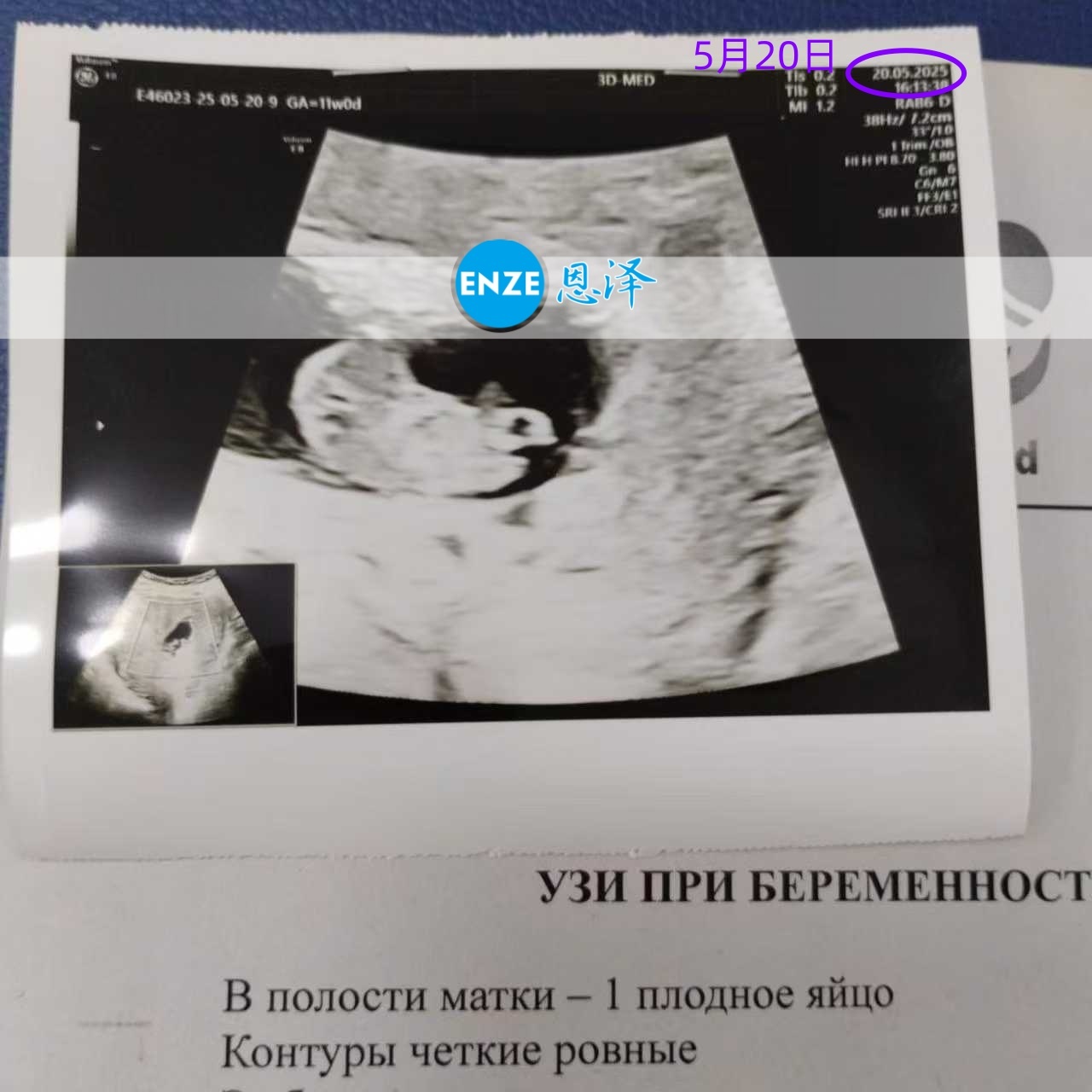 恩泽格鲁吉亚代孕代母9周检查顺利通过
