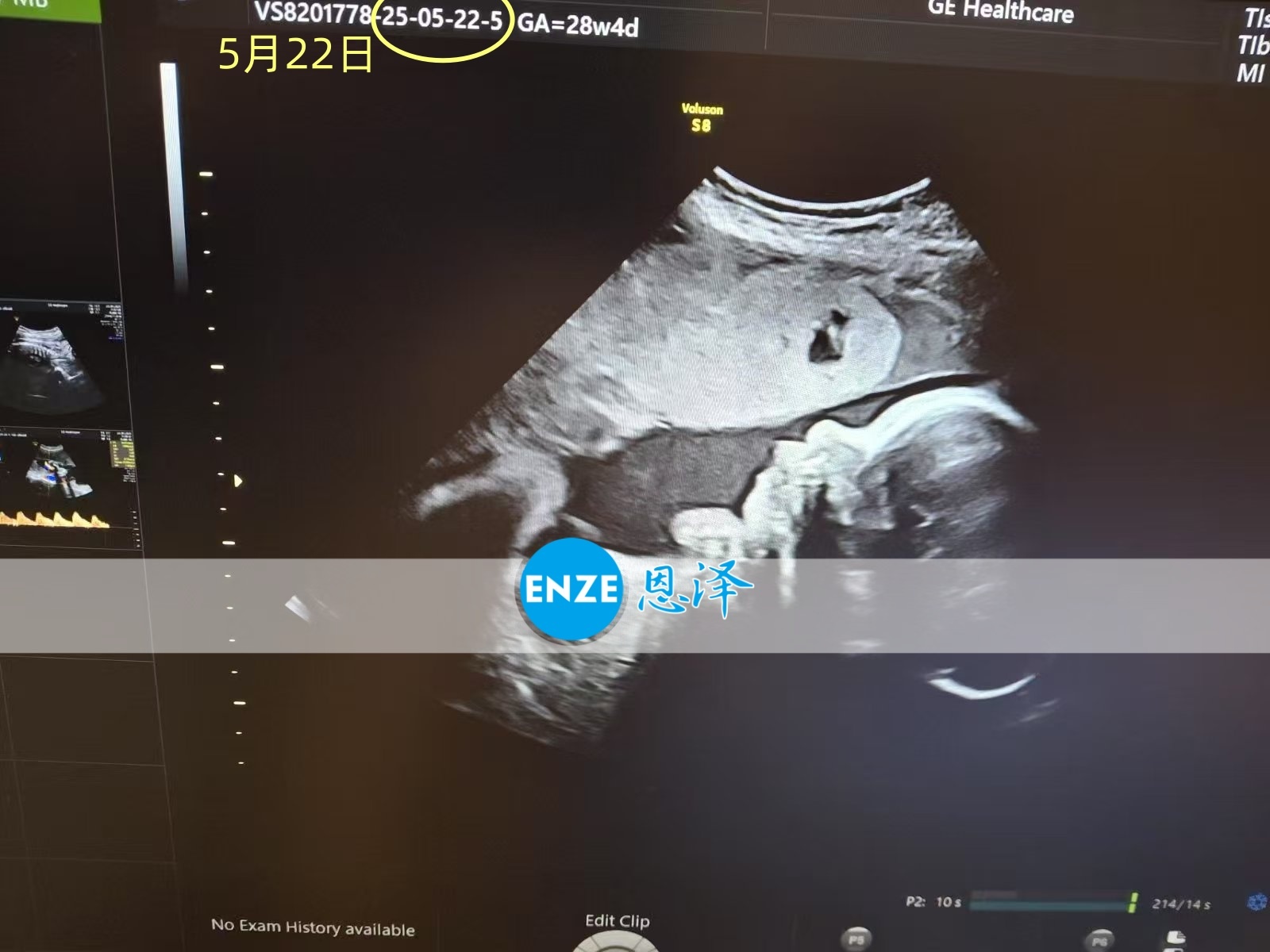 恩泽乌克兰代孕代母28周产检顺利通过